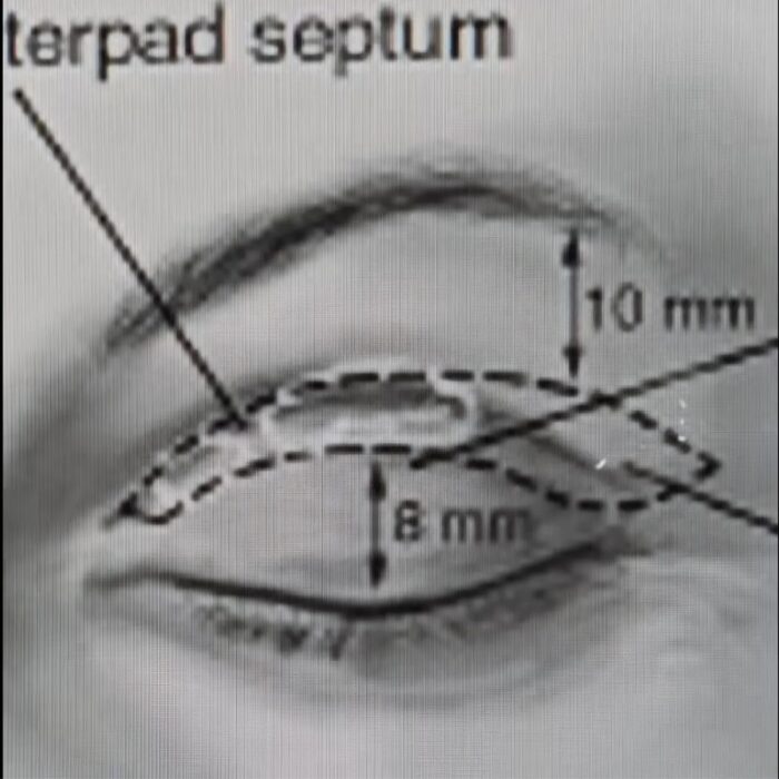 Blefaropastia en Cuernavaca